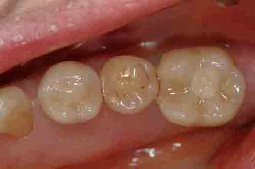 Photo of prosthodontics