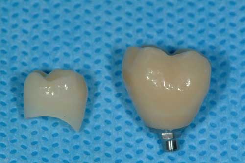 Photo of prosthodontics